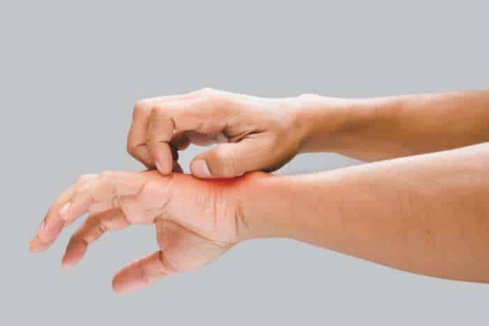 esempio per prurito puntura pappataci