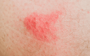 puntura dengue